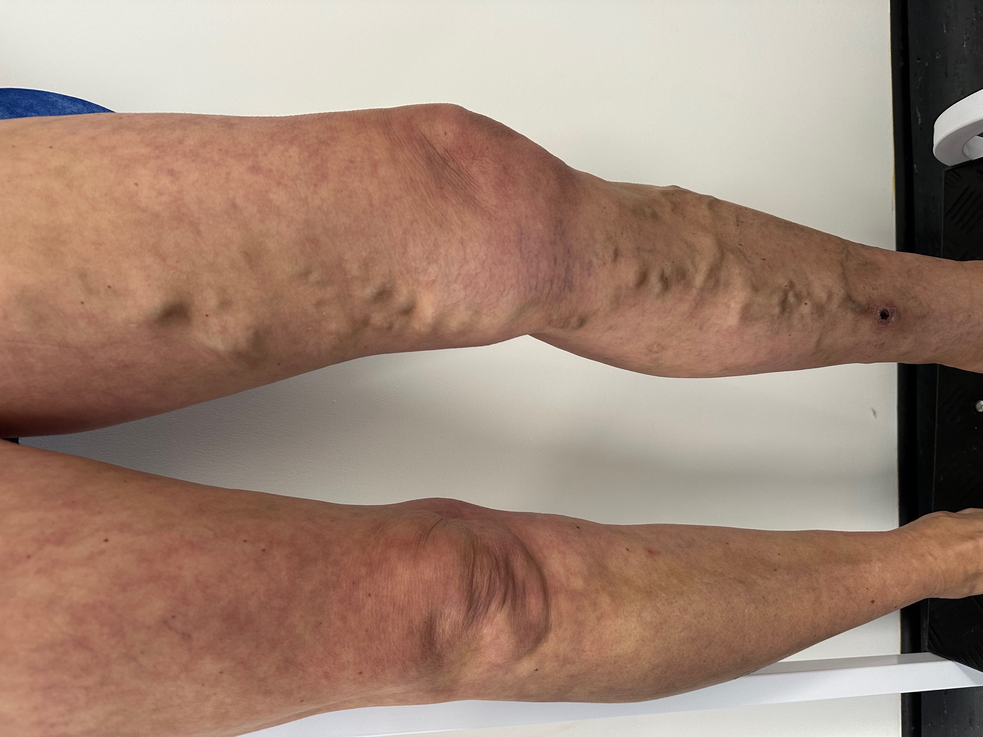 Why Do My Legs Hurt When I Walk? 
